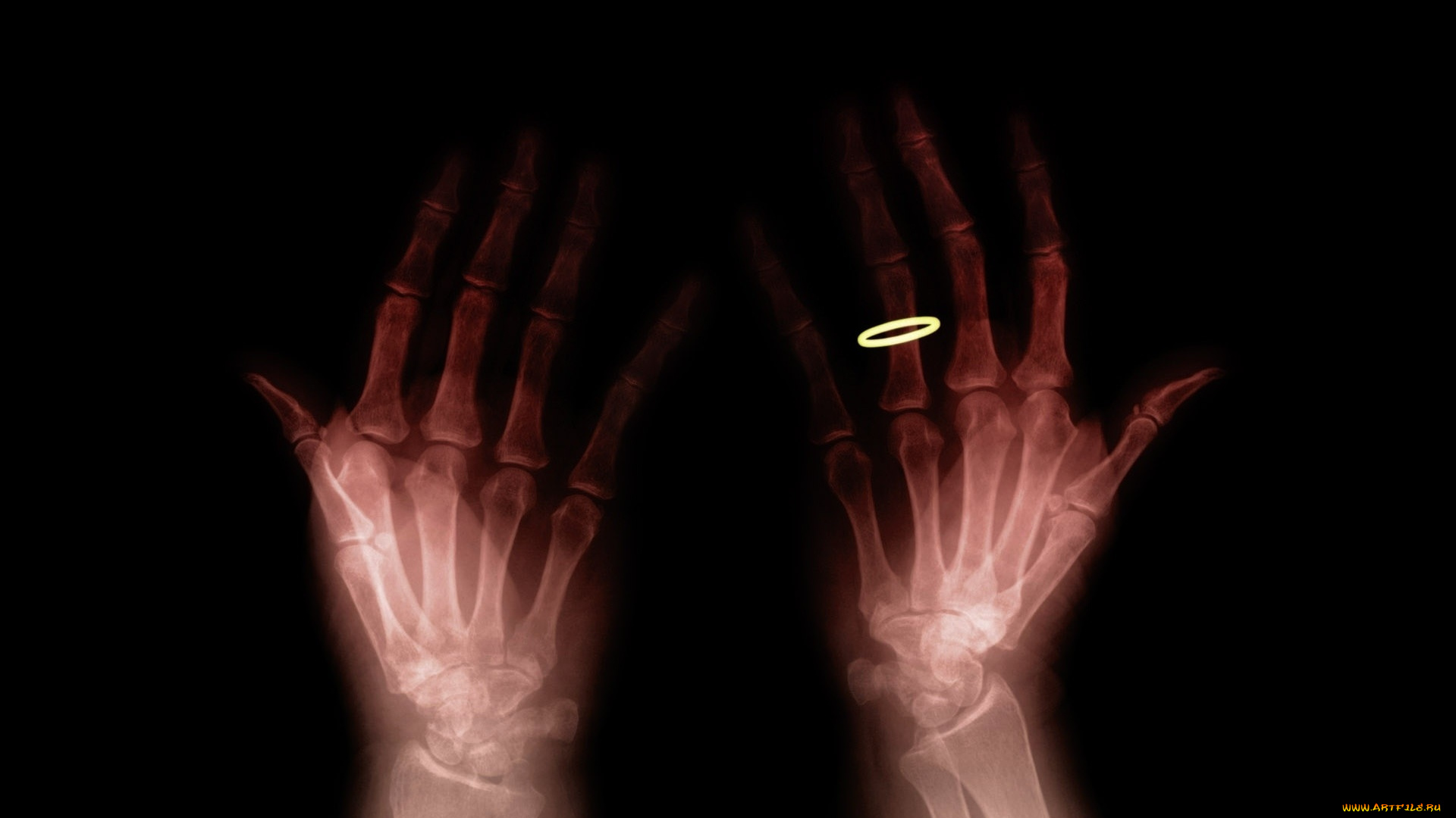 разное, кости, , рентген, руки, кольцо