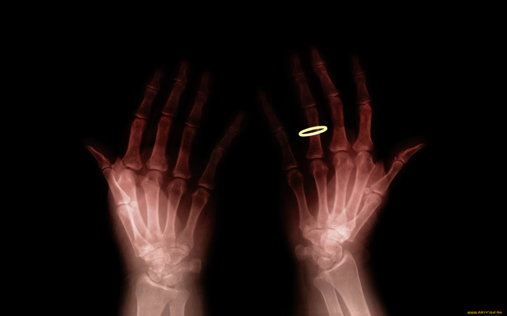 разное, кости, , рентген, руки, кольцо
